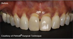 gum recession before pinhole